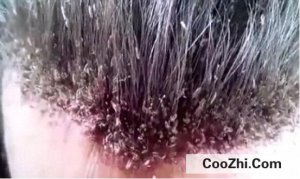 ͷ�ϳ�ʭ����ôȥ��